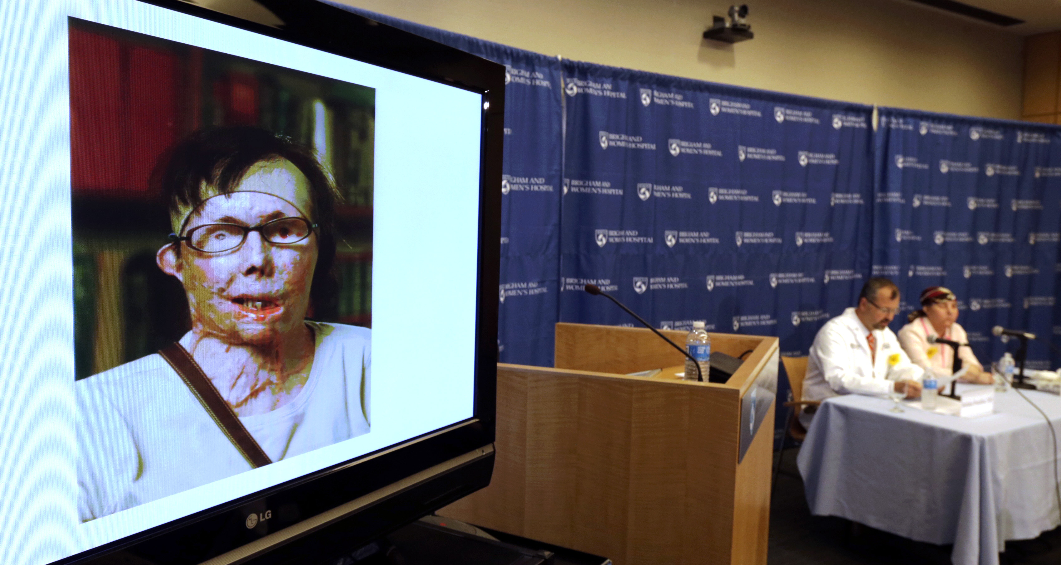 Brigham and Women's Hospital performs facial transplant in 2013